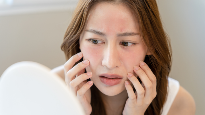 原因は腸かも？肌荒れと腸内環境の深い関係の画像